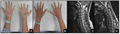 Interobserver and Intraobserver Reproducibility and Reliability of the Huashan Clinical Classification System for Hirayama Disease